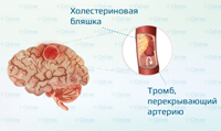 Инфаркт мозга неуточненный